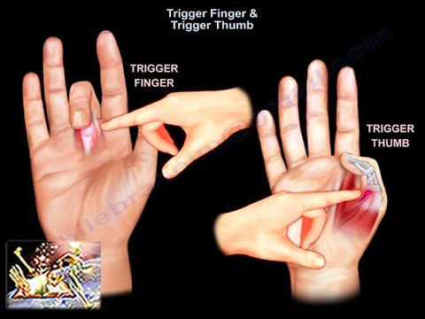trigger finger and trigger thumb